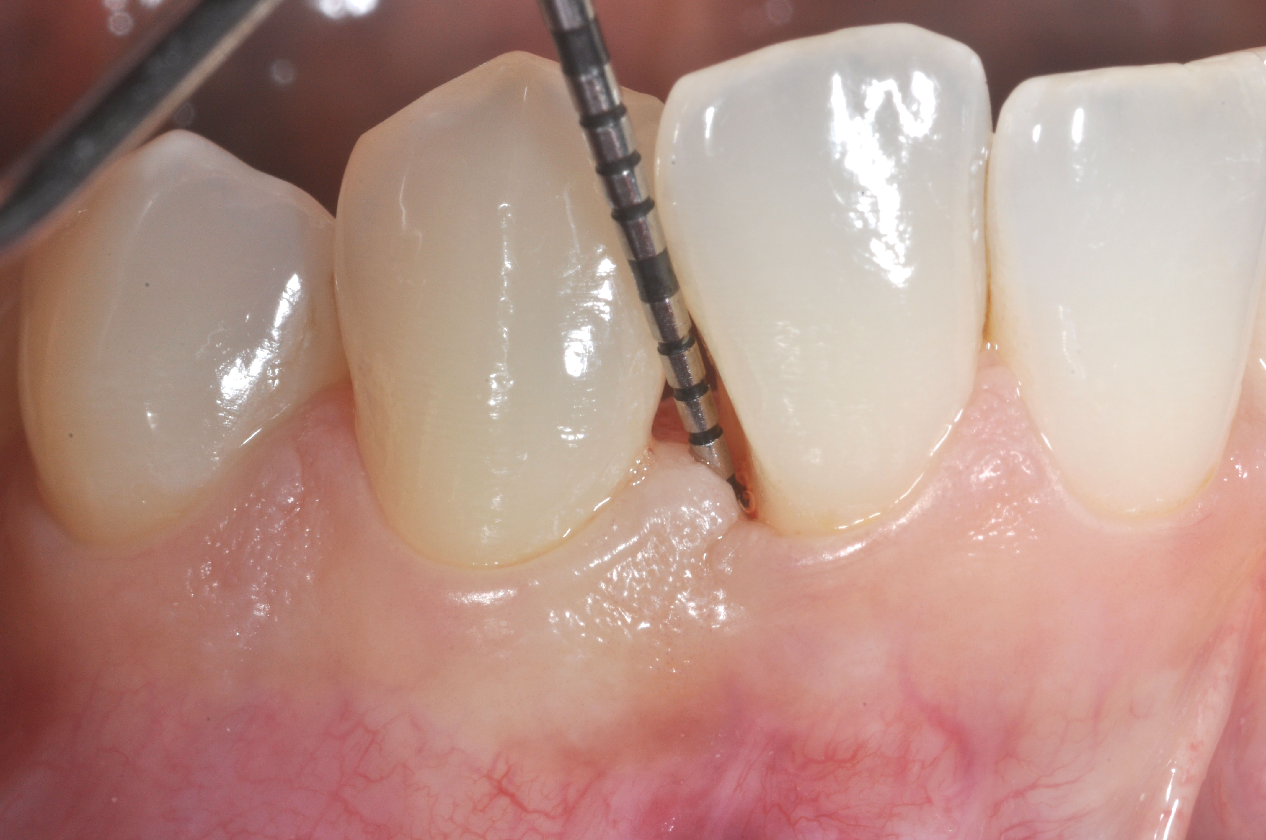 Sono Guarito Dalla Parodontite Forum parodontite_01 - Studio Medical San Giorgio